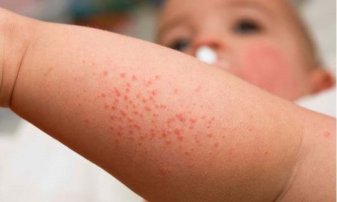 Tình hình dịch sởi ở khoa Truyền nhiễm Bệnh viện trẻ em Hải Phòng