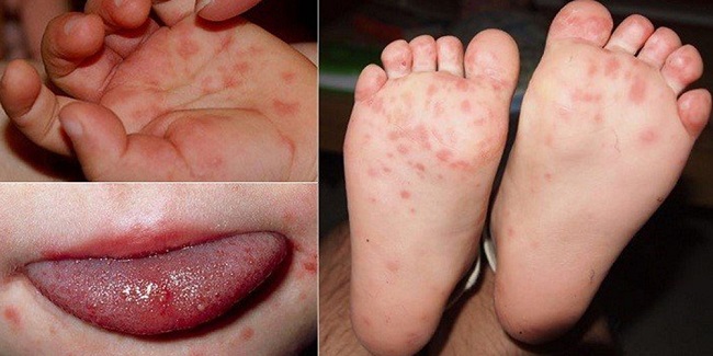 Tuyên truyền phòng chống bệnh chân tay miệng