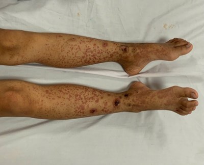 “Trẻ nổi ban, đau bụng khi trời lạnh. Đừng chủ quan- Đó có thể là Schönlein–Henoch!”