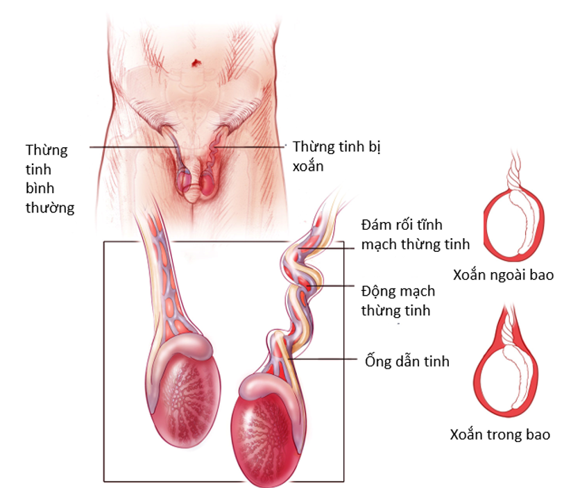 Xoắn tinh hoàn (Testicular Torsion)