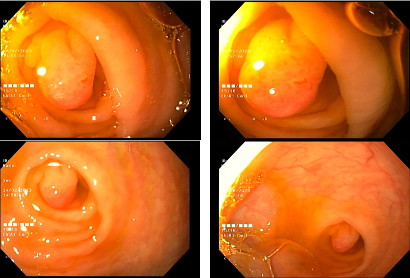 Polyp tại lỗ ruột thừa - một trường hợp hiếm gặp
