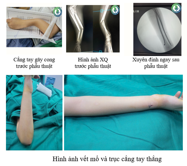 Phẫu thuật kết hợp xương cẳng tay bằng phương pháp ưu việt nhất cho bệnh nhi
