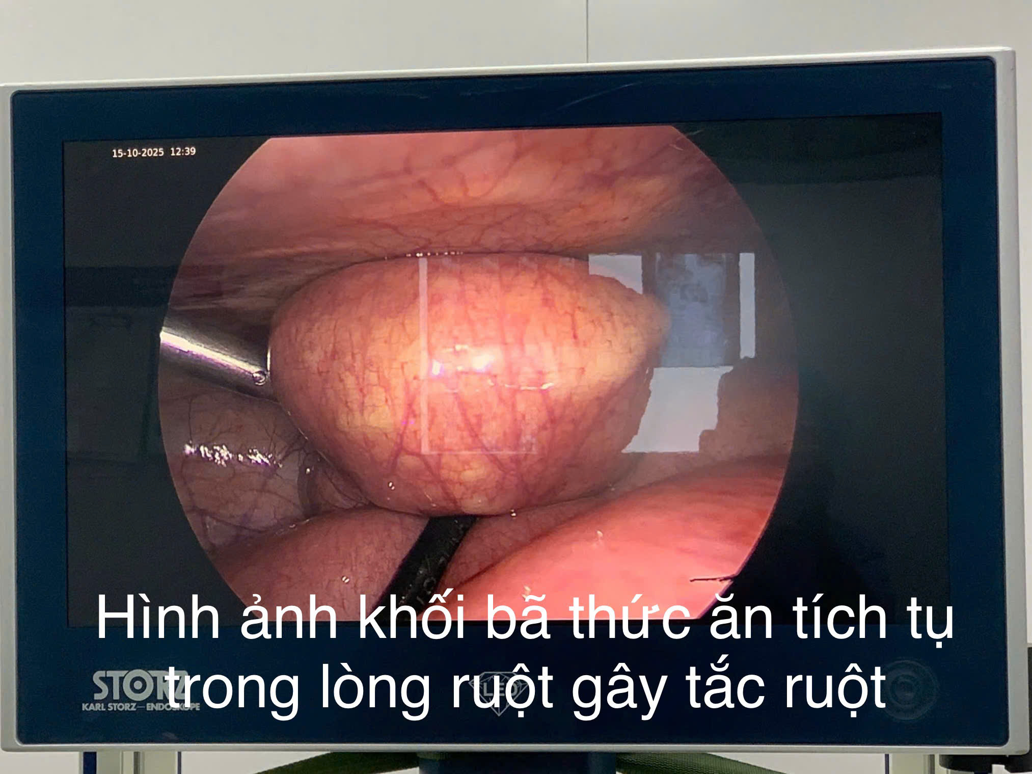 PHẪU THUẬT NỘI SOI ĐIỀU TRỊ TẮC RUỘT DO BÃ THỨC ĂN TẠI BỆNH VIỆN NHI HẢI PHÒNG.