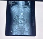 CẢNH BÁO NGUY HIỂM GÂY TỔN THƯƠNG NẶNG ĐẾN ĐƯỜNG TIÊU HÓA CỦA TRẺ