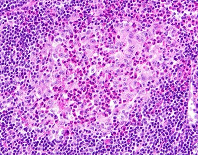 BỆNH MÔ BÀO LANGERHANS Ở TRẺ EM - KHI TẾ BÀO MIỄN DỊCH “PHÁT TRIỂN SAI HƯỚNG”