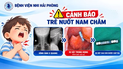 CẢNH BÁO: TRẺ NUỐT NAM CHÂM TRONG ĐỒ CHƠI XẾP HÌNH – MỐI NGUY HIỂM KHÔNG THỂ CHỦ QUAN!